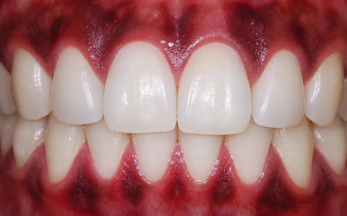 Close-up showing different gum colours and pigmentation variations on healthy gum tissue