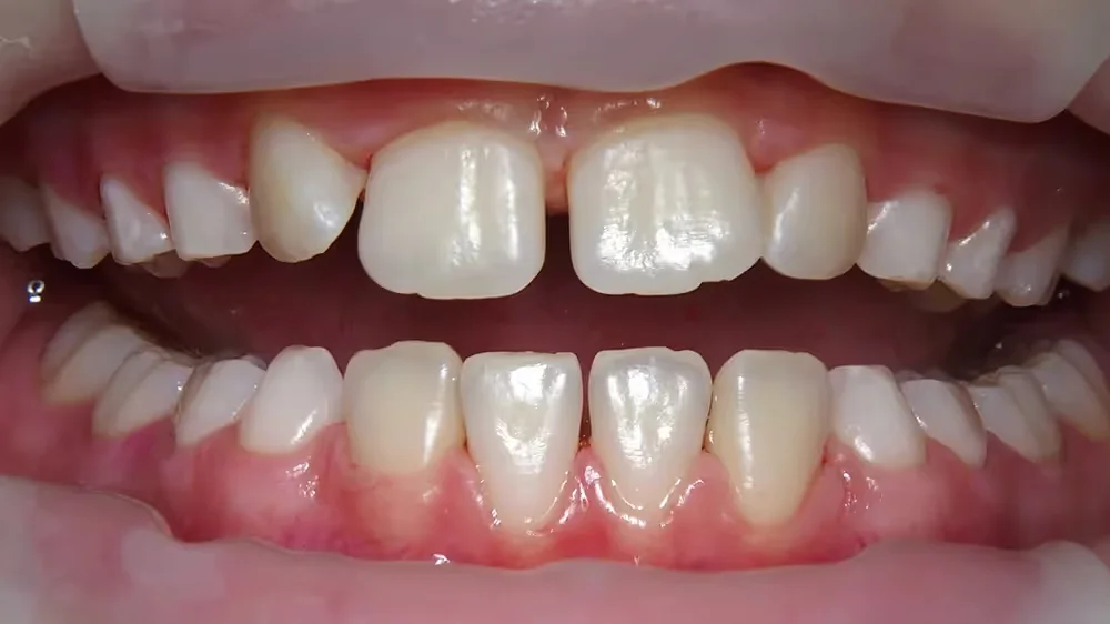 After GBT cleaning – child patient teeth clean and polished after Airflow treatment