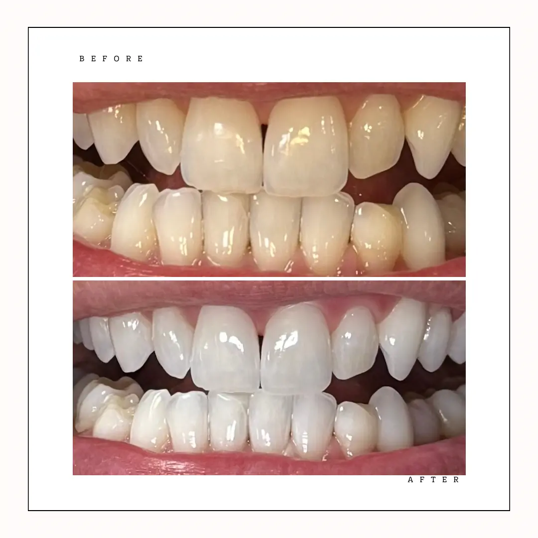 Philips Zoom teeth whitening before and after result at Krystal Dental Hygiene Toronto – Case 1