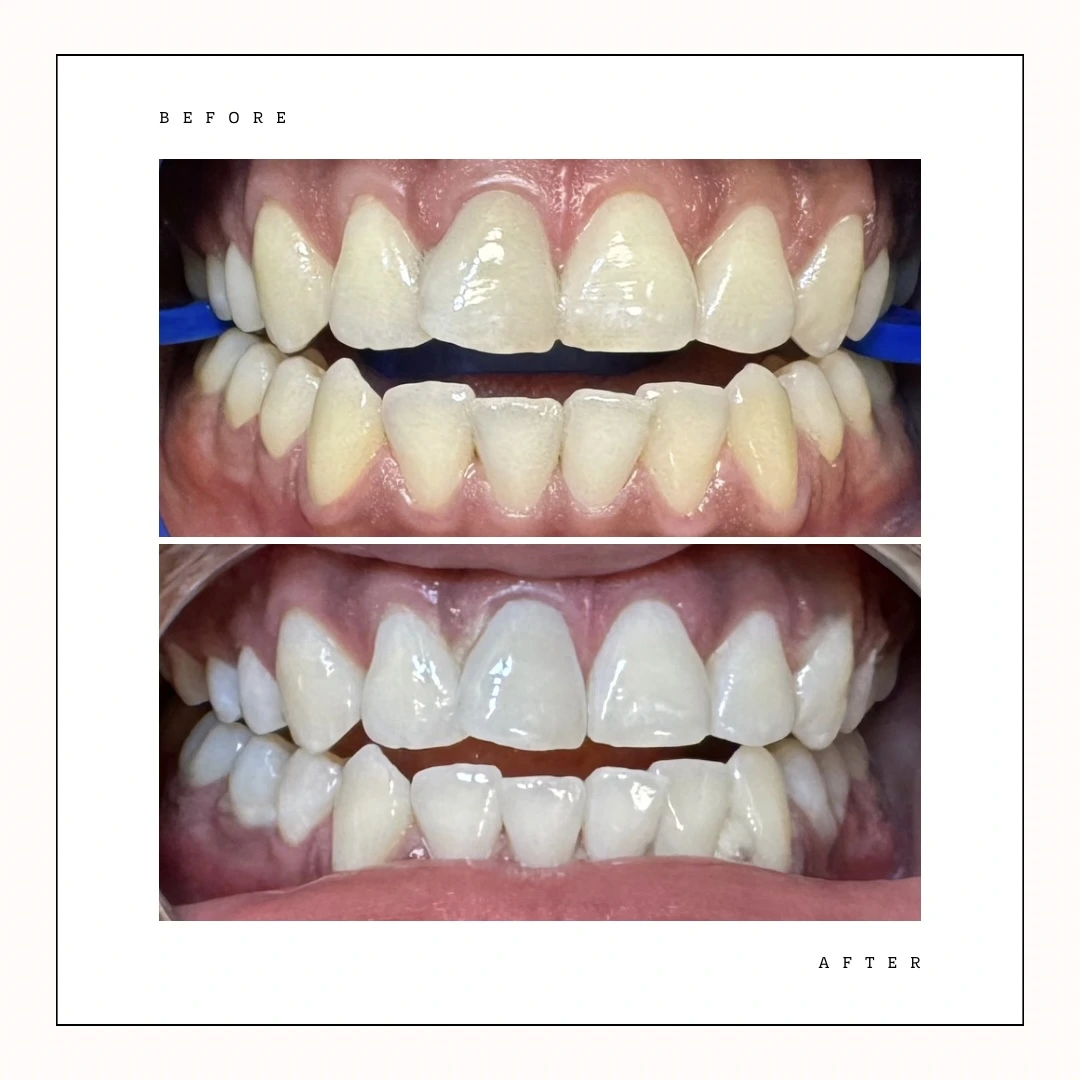 Zoom whitening results at Fort York Toronto dental studio – Case 3