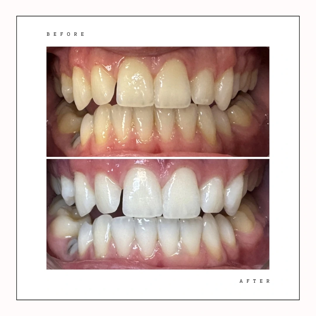 Before and after professional teeth whitening session in Toronto – Case 4