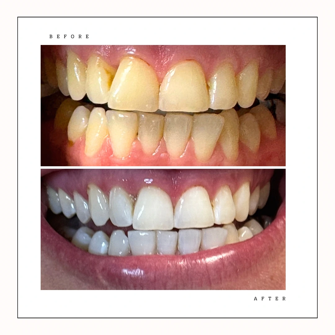 Zoom whitening transformation at Krystal Dental Hygiene Fort York – Case 8