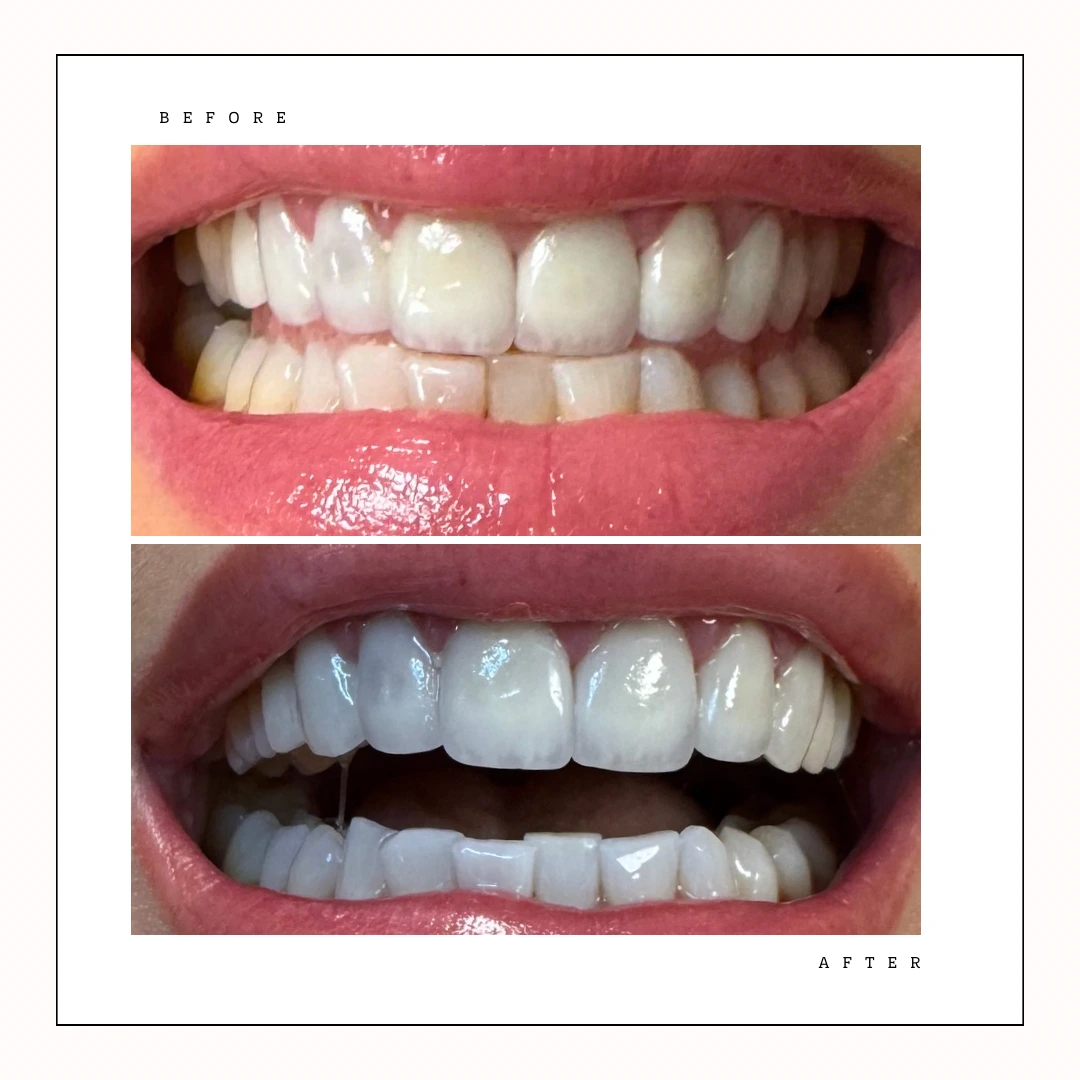 Philips ZOOM teeth whitening results – bright smile transformation Toronto – Case 10