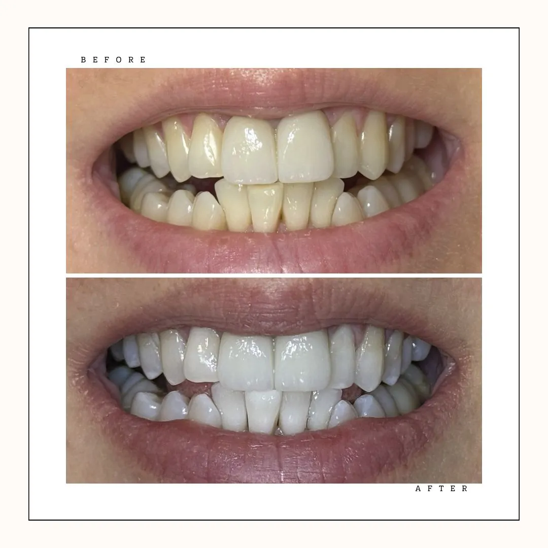 Krystal Dental Hygiene – résultat spectaculaire blanchiment professionnel Toronto – Cas 13